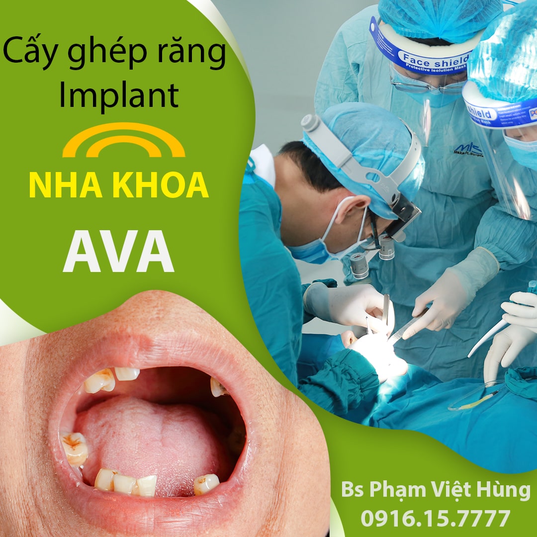 cay-ghep-rang-implant